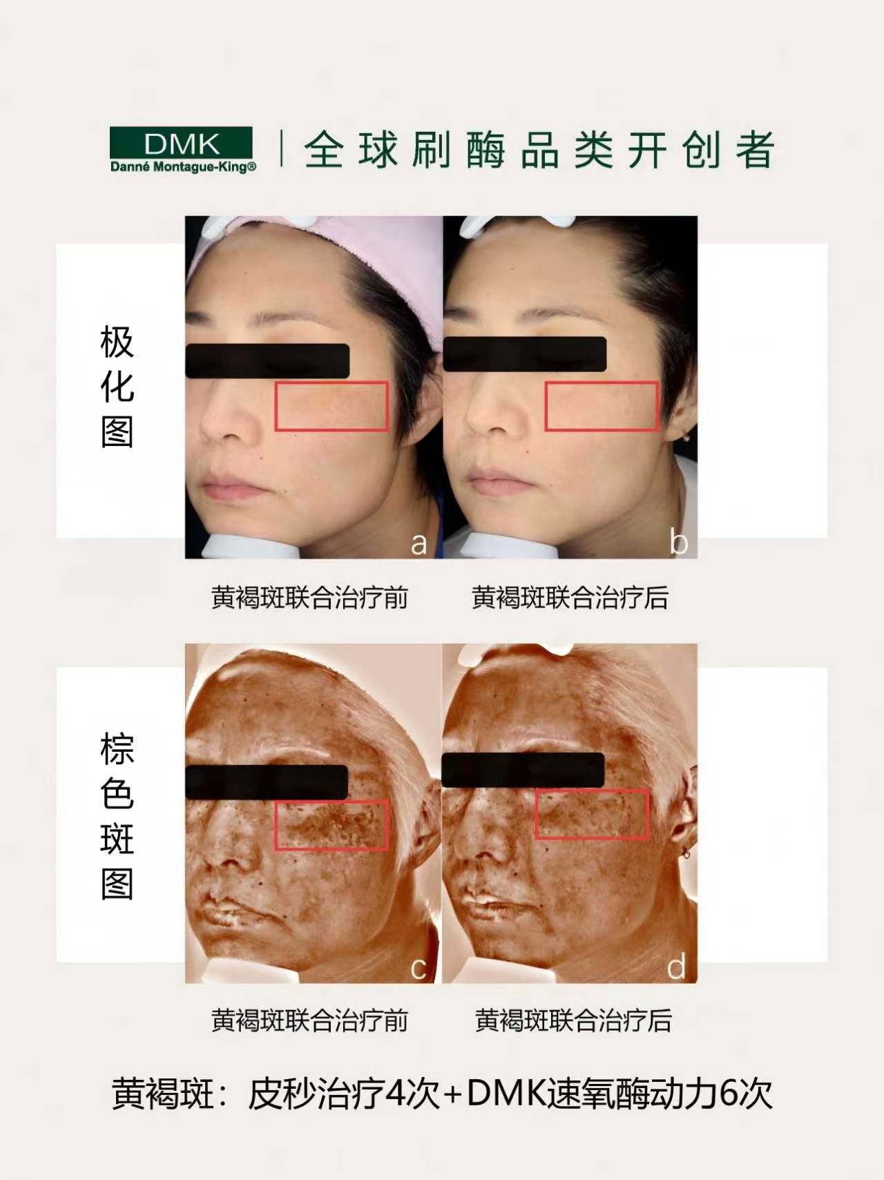 黄褐斑皮秒治疗后,联合美国DMK刷酶
